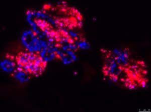 Mikroskopische Aufnahme von Darmepithelzellen in der Petrischale. Ohne das Molekül cFlip sterben die Zelle massenhaft ab (rot). Zellkerne sind in Blau dargestellt. (Bild: Dr. Nadine Wittkopf, Medizinische Klinik 1)