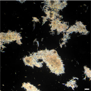 Die Gichtknoten entstehen, wenn das Immunsystem die nadelspitzen Gichtkristalle ummantelt und damit die Entzündung stoppt. (Bild: FAU)