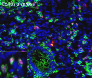 In den hier rot bzw. grün markierten Zellen des Darmgewebes, den Th-9-Zellen, wird der Botenstoff gebildet, der die chronischen Entzündungen auslösen kann. (Bild: Uni-Klinikum Erlangen)
