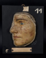 Ausstellung: Die Moulagensammlung der Hautklinik