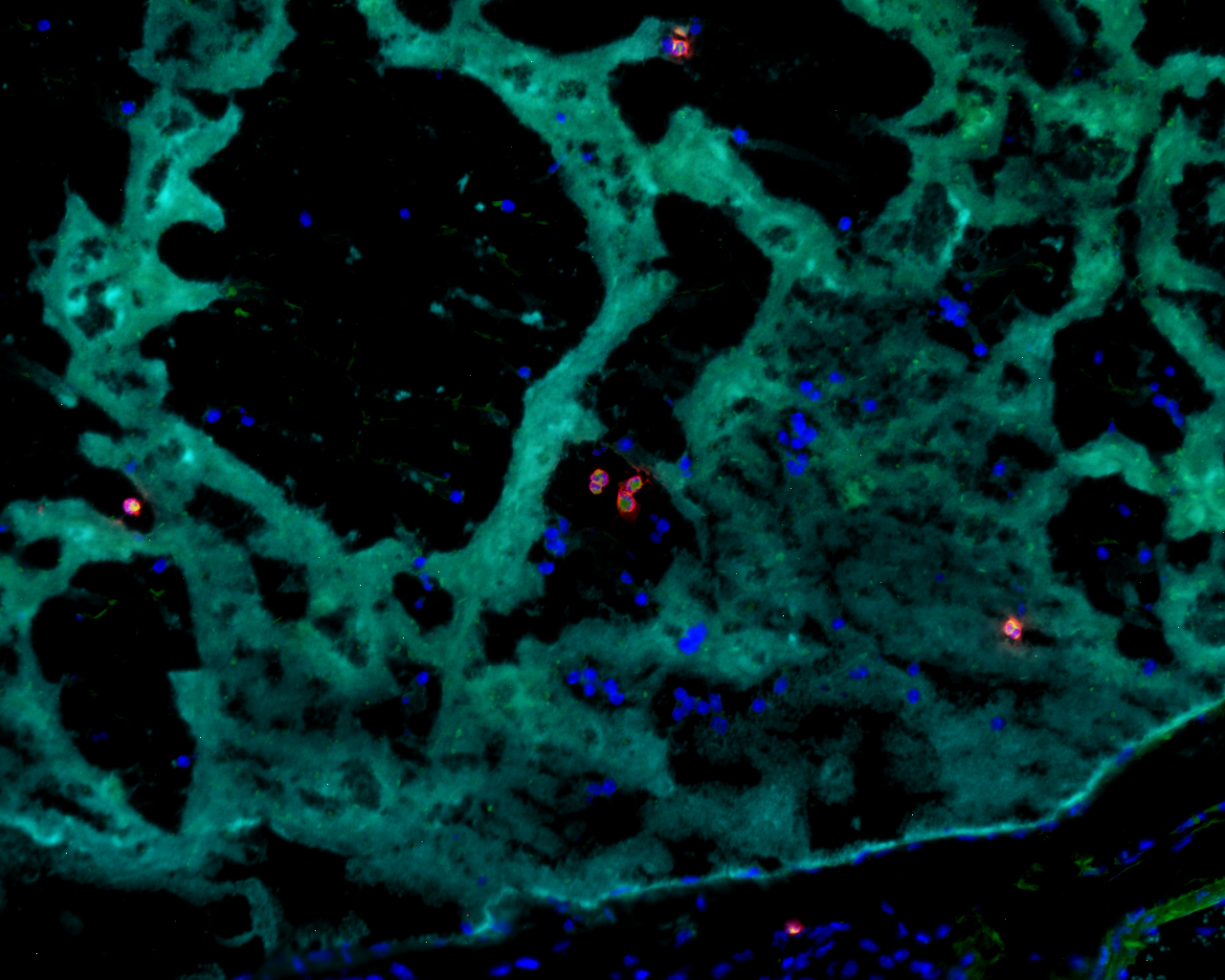 Eosinophile Granulozyten (rote Zellen) tragen innerhalb einer Thrombose (sog. Thrombozyten sind in türkis gefärbt) zum Thrombuswachstum bei. (Bild: FAU/Jochen Ackermann)