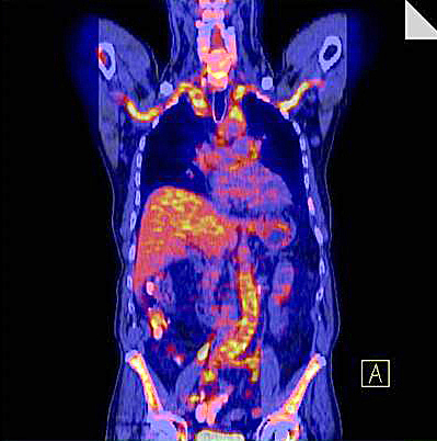 Diagnostische PET-CT-Aufnahme einer Aortitis