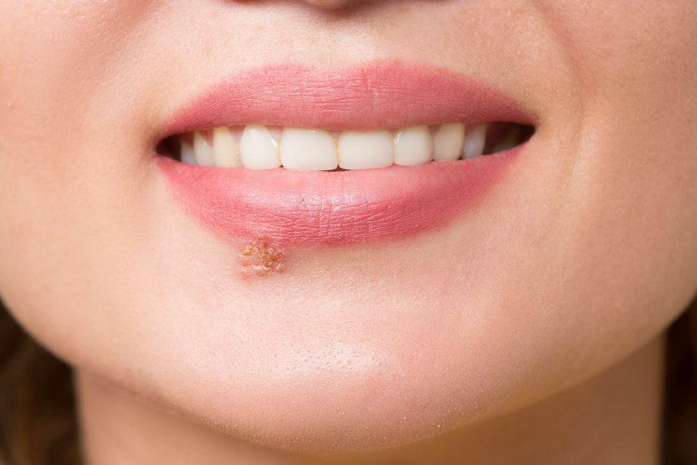 Zum Artikel "Mit körpereigenem Protein Herpes bekämpfen"