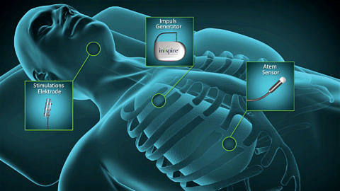 Grafik eines Menschen mit den Komponenten des Zungenschrittmachers.