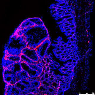 Gewebeschnitt eines Tumors