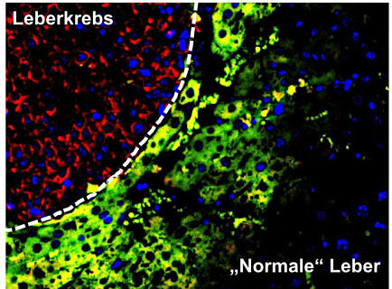 Leberkrebszellen