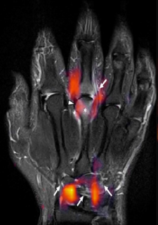 Zum Artikel "Arthritis bereits im MRT erkennen"