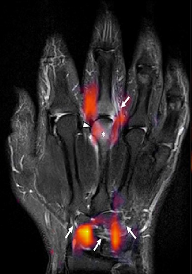 Ein dunkler MRT Scan einer Hand. Einige Stellen sind rot markiert.