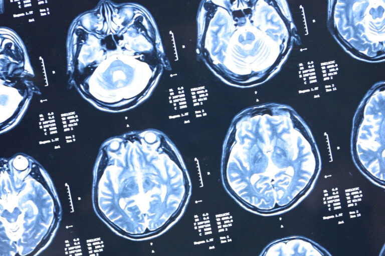 Wie Tumorzellen im Gehirn das Immunsystem ausbremsen