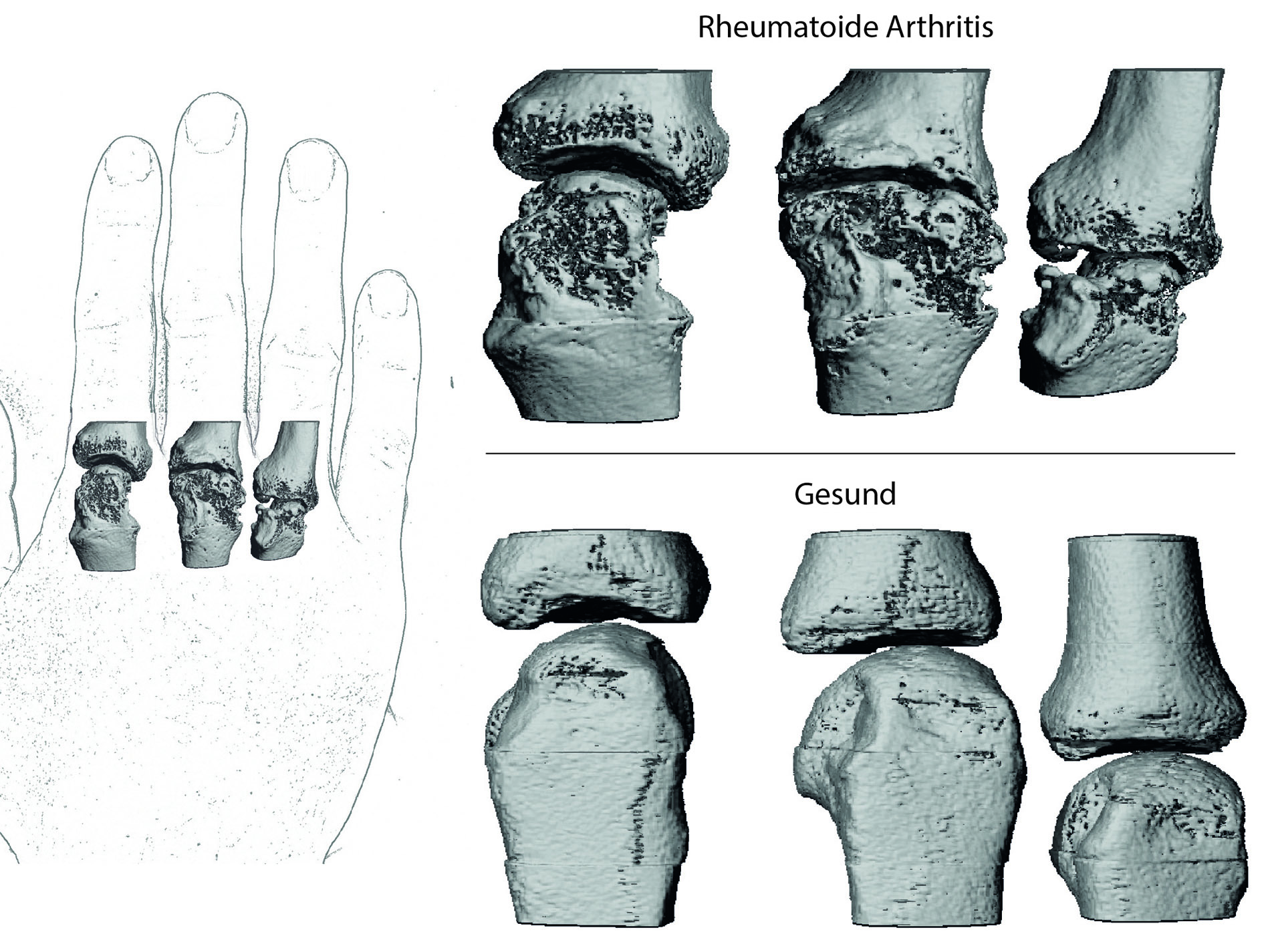 XtremeCT Aufnahmen der Mittelhandgelenke im gesunden Zustand (unten) und bei fortgeschrittener rheumatoider Arthritis (Bild: FAU/ A.Kleyer/Medizin3)