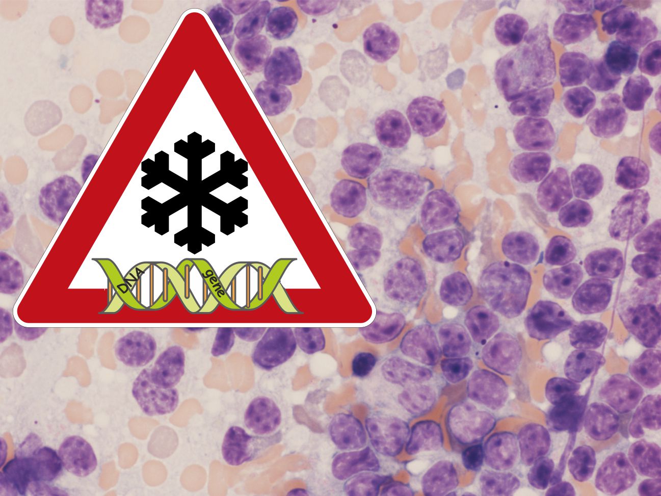 Knochenmarkszellen, die an Präleukämie leiden, aber noch keine Symptome der Leukämie aufweisen, unter dem Mikroskop.