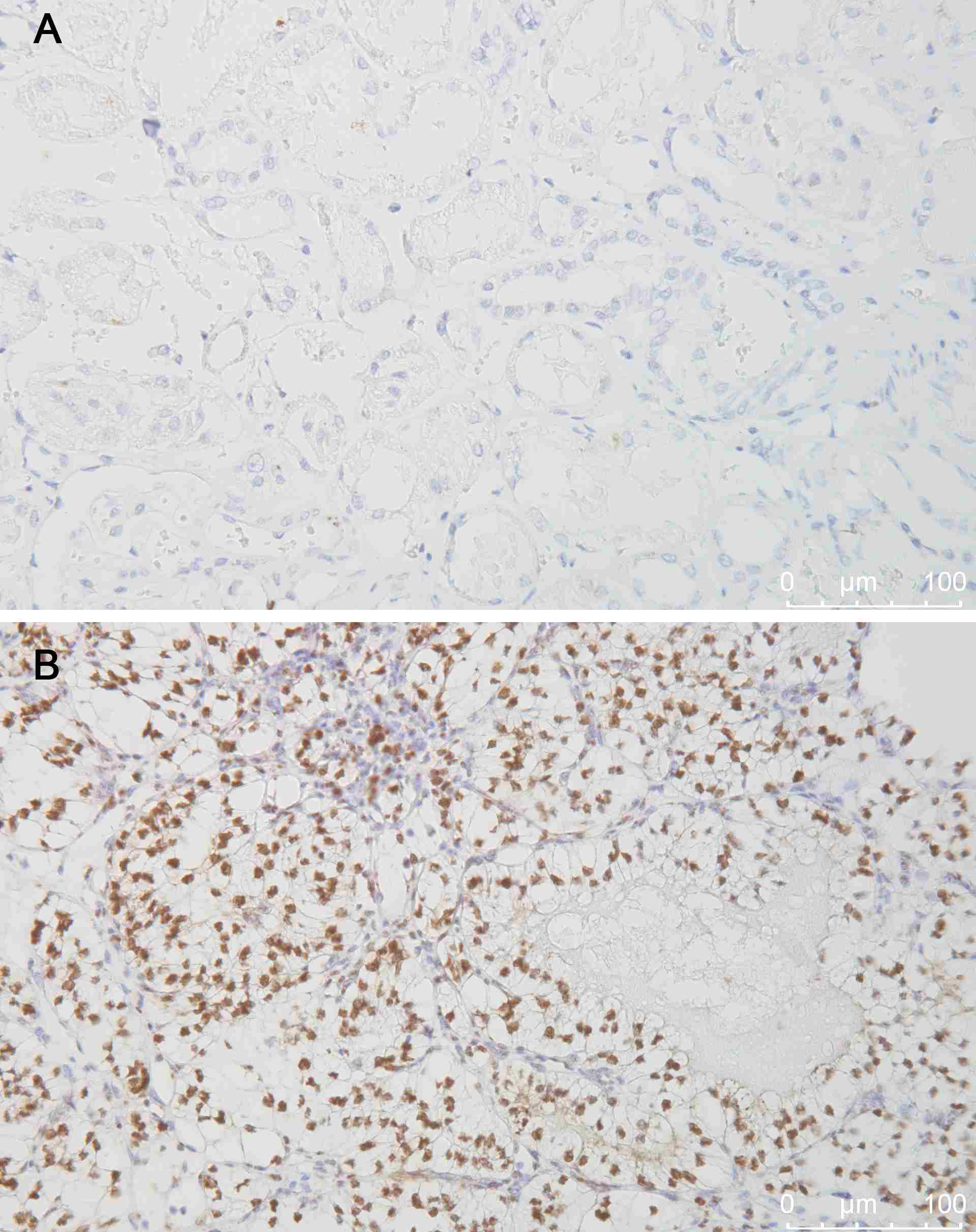 Immunhistochemische Färbung (braun) des Hypoxie-induzierbaren Faktors 1 (HIF1) in normalem Nierengewebe (A) und einem Schnitt durch einen VHL-mutierten Nierentumor (B).