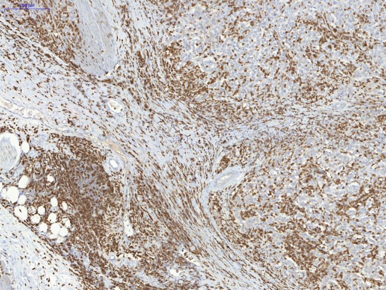 Weiße Blutkörperchen geben Auskunft über Therapieerfolg