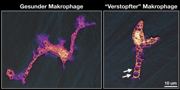 Verstopfung in Abwehrzellen löst Entzündung aus