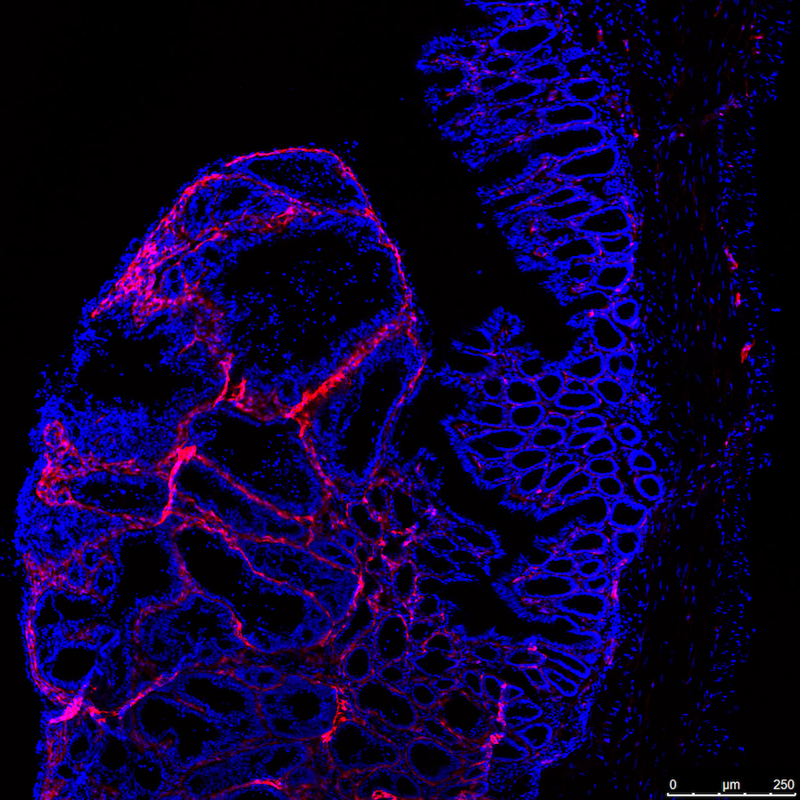Gewebeschnitt eines Tumors