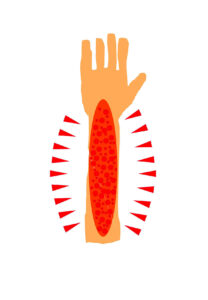 Illustration: Ausbruch der Schuppenflechte