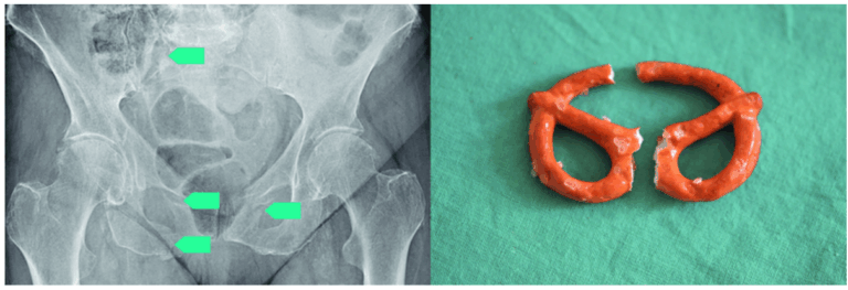„Das Becken bricht wie eine Salzbrezel“