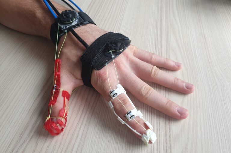 Wiederherstellung der Handfunktion mit intelligenter Neuroorthese
