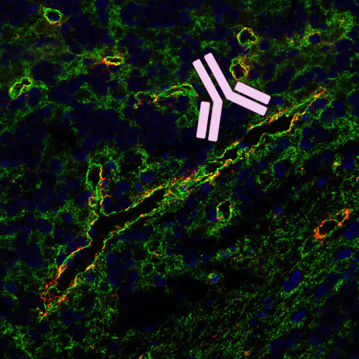 Seltene neurologische Autoimmunerkrankung: MLC1-Antikörper als möglicher Auslöser identifiziert